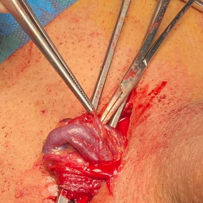 دوالي الخصية الميكروسكوبية